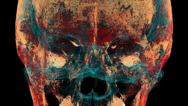 Ученые НГУ при компьютерной томографии черепа женщины пазырыкской культуры выявили свидетельства хирургической операции