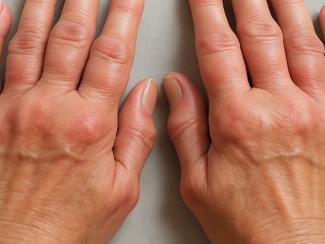 Как обеспечить россиян необходимым лечением ревматических заболеваний