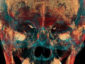 Ученые НГУ при компьютерной томографии черепа женщины пазырыкской культуры выявили свидетельства хирургической операции